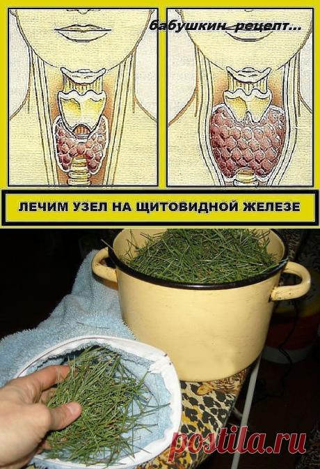 Лечим узел на щитовидной железе и снимаем артериальное давление.