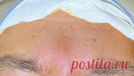 Врачи достали из-под кожи лба россиянина 12-сантиметрового червя. Жителю Саратова удалили червя из лобной области. Об этом сообщает Саратовская городская клиническая больница N9 в официальных соцсетях. Мужчина заметил припухлость на лице и обратился к врачам. Специалисты назначили ему медикаментозное ...