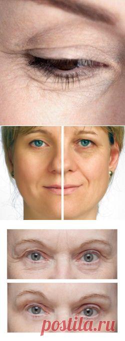 Морщины под глазами: как избавиться (убрать)