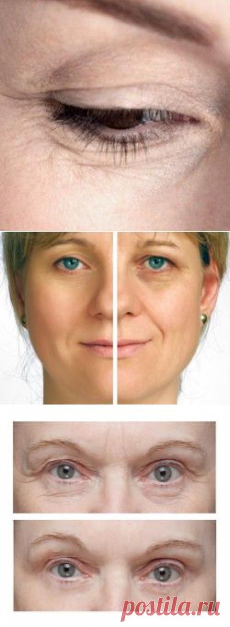 Морщины под глазами: как избавиться (убрать)