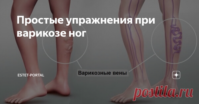 Простые упражнения при варикозе ног Варикозное расширение вен на ногах – довольно распространенная проблема, которая приносит множество неудобств, в том числе связанных с неэстетичным вздутием вен и отечностью, болях в ногах, тяжестью, судорогами. Симптомы заболевания варьируются в зависимости от конкретного случая.
