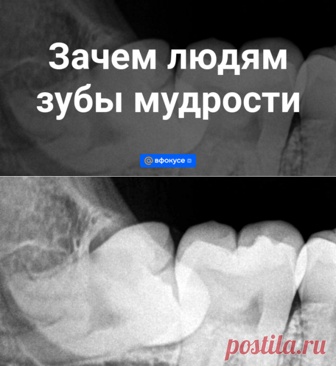 Зачем людям зубы мудрости - ВФокусе Mail.ru
