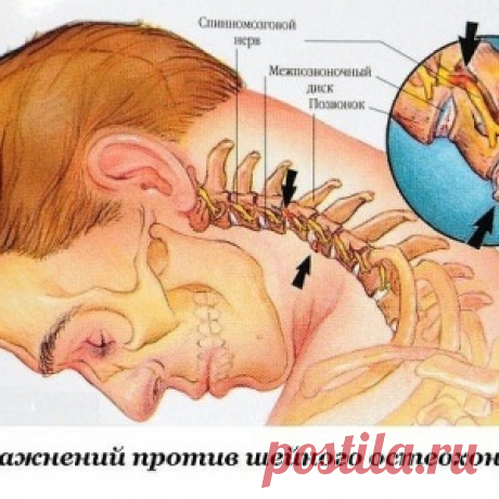 Восемь упражнений против шейного остеохондроза - МирТесен