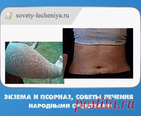 Экзема и псориаз, советы лечения народными средствами.