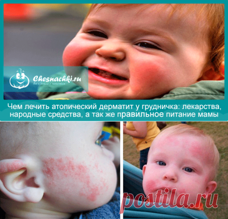 Атопический дерматит у грудничка: чем лечить и какая диета у мамы?