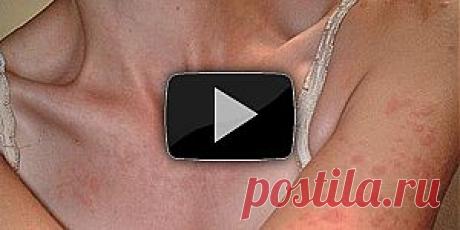 Subscribe. Здоровье - Боремся с сыпью - svetlana.vashuk61@mail.ru - Почта Mail.Ru