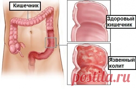 Домашние средства для лечения язвенного колита - Шаг к Здоровью