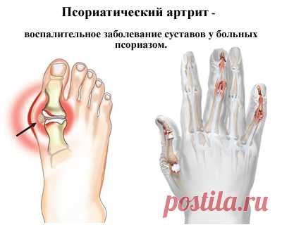 Псориатический артрит - симптомы и фото. Псориатический артрит без псориаза