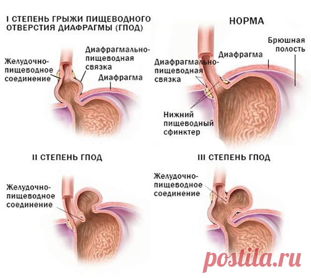 Грыжа пищеводного отверстия диафрагмы лечение без операции и образ жизни | Подольская городская детская поликлиника № 3
