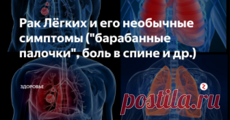 Рак Лёгких и его необычные симптомы ("барабанные палочки", боль в спине и др.) Все мы знаем о длительном кашле, боле в груди и других известных симптомах. Но знаете ли вы о менее заурядных признаках?