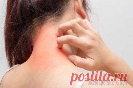 Атопический дерматит у взрослых симптомы и лечение Атопический дерматит – хроническое заболевание, которое сопровождается зудом. Он является одним из самых распространенных аллергических проявлений. Если раньше его относили больше к детским болезням, ...