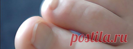 Лечение грибка ногтей. | pokolenie-x.com