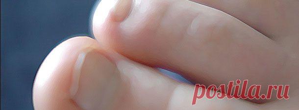 Лечение грибка ногтей. | pokolenie-x.com