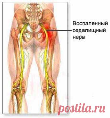 Упражнения при невралгии наружного кожного нерва бедра