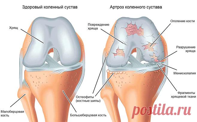 Настойка Иннокентьевского деда спасла мне колени — боль ушла, и не возвращается! Записывайте «золотой» рецепт!