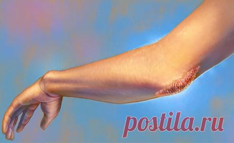 Псориаз – физическое отражение душевных конфликтов