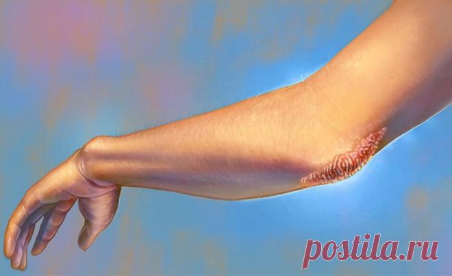 Псориаз – физическое отражение душевных конфликтов