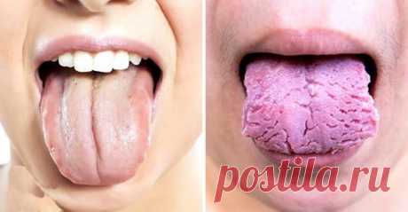 3 вещи, которые ваш язык пытается рассказать о вашем здоровье