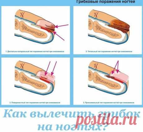 Как вылечить грибок на ногтях?