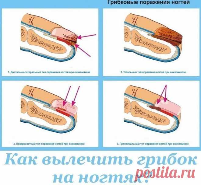 Как вылечить грибок на ногтях?