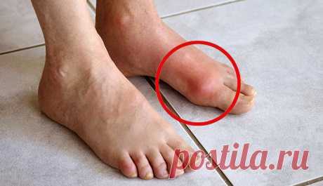 Подагра: 8 продуктов, которые могут ее вызвать