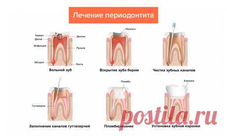 Периодонтит — симптомы, лечение острых и хронических форм, виды — Startsmile