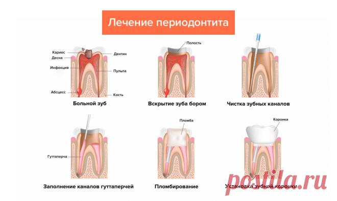 Периодонтит — симптомы, лечение острых и хронических форм, виды — Startsmile