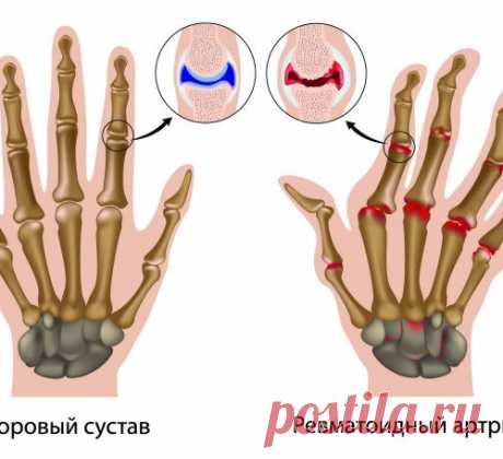 РЕВМАТОИДНЫЙ АРТРИТ - СИМПТОМЫ И ЛЕЧЕНИЕ....