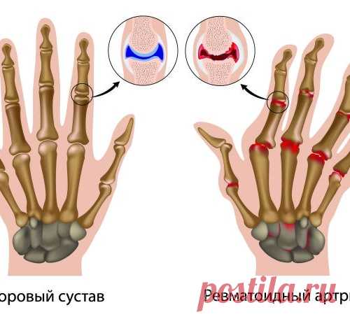 РЕВМАТОИДНЫЙ АРТРИТ - СИМПТОМЫ И ЛЕЧЕНИЕ....
