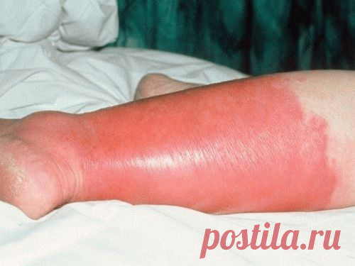Покраснение и отек ноги ниже колен: что это, причина покраснения и лечение