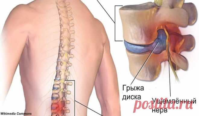 Комплекс ежедневных упражнений, который поможет вам с Грыжой межпозвоночного диска  

 
Подробная фотоинструкция. Через 6 месяцев все исчезло!
Грыжа межпозвоночного диска — явление, к сожалению, довольно распространённое и зачастую крайне болезненное. Межпозвоночные диски — это «про…