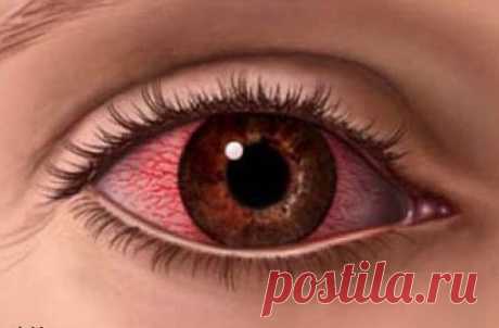 Причина покраснение глаз и методы устранения