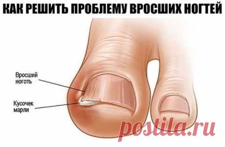 Как правильно решить проблему вросших ногтей и что такое ногтоеда?
Ногтоеда — это достаточно болезненное и причиняющее сильный дискомфорт состояние, при котором кожа вокруг ногтя воспаляется (может быть из-за врастания ногтя), а в некоторых случаях и сопровождается наличием инфекции.
В сегодняшней статье мы хотели бы обратиться к этой проблеме, рассказать о симптомах и возможных причинах такого