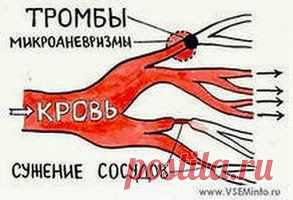 Удаляем тромбы луком | Друг пенсионера