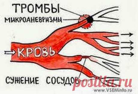 Удаляем тромбы луком | Друг пенсионера