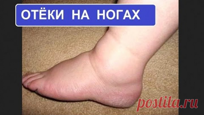 Отёки на ногах. Причины