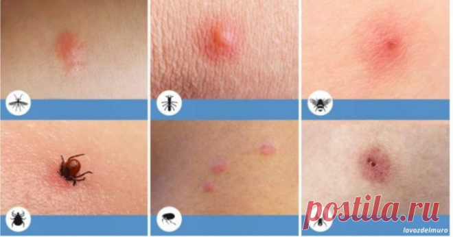 8 типов укусов насекомых, о которых вы просто обязаны знать! Весной и летом во время вылазок на природу и прямо дома нас всех часто кусают какие-то насекомые. Чтобы избежать непредвиденных и неприятных последствий, очень важно научиться различать укусы и правильно их обрабатывать.

Вот 9 самых распространённых укусов:

Укус комара.



Комариный укус в