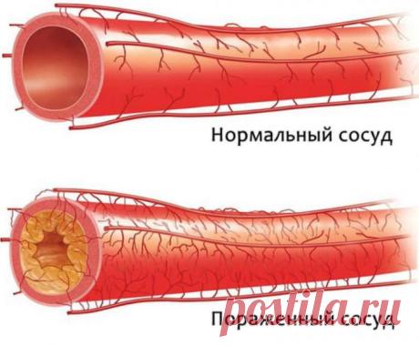 Старое немецкое средство поможет быстро очистить артерии и укрепить организм - mojakuhnja.ru