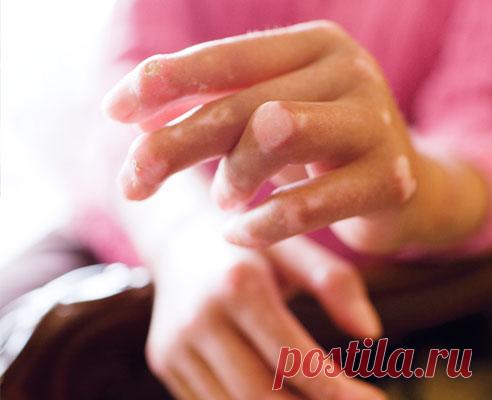 Народные рецепты лечения склеродермии