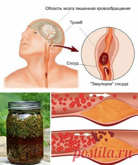 От сужения сосудов головного мозга! Выпей 25 капель и головная боль исчезн.
Настойка валерианы 100 мл
Настойка эвкалипта 100 мл
Настойка пиона 50 мл
Настойка пустырника 100 мл
Настойка мяты перечной 50 мл
Настойка боярышника 100 мл
10 шт гвоздики
1 столовая ложка мёда
10 гр порошка имбиря
 настаиваться в тёмное место на 25 дней, периодически встряхивать. Затем процедить.