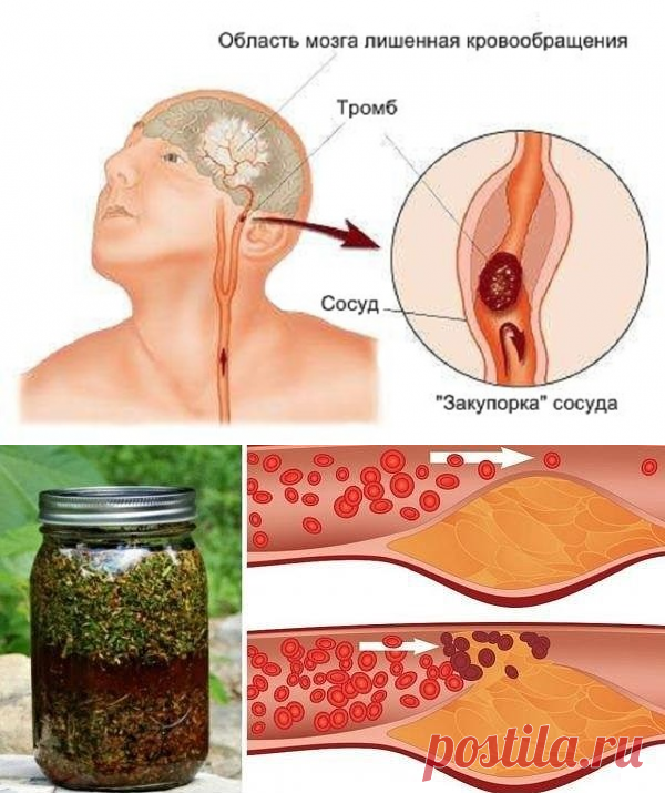 От сужения сосудов головного мозга! Выпей 25 капель и головная боль исчезн.
Настойка валерианы 100 мл
Настойка эвкалипта 100 мл
Настойка пиона 50 мл
Настойка пустырника 100 мл
Настойка мяты перечной 50 мл
Настойка боярышника 100 мл
10 шт гвоздики
1 столовая ложка мёда
10 гр порошка имбиря
 настаиваться в тёмное место на 25 дней, периодически встряхивать. Затем процедить.