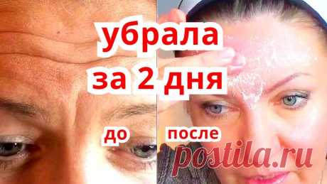 Супер Маска от Морщин на Лбу и Межбровной Морщины Убрала Всего за 3 Дня Я покажу как убрала глубокую морщину на лбу и межбровку всего за 2-3 дня в домашних условиях.  Как убрать морщину на лбу — самые эффективные  способы от глуб...