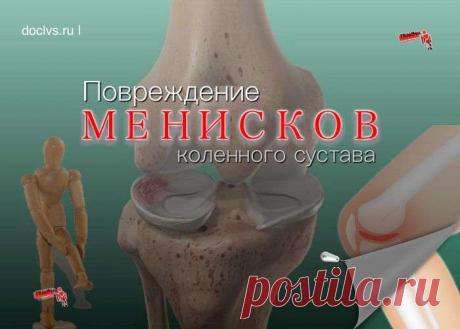 Травма мениска может произойти от неудачного движения даже при обычной ходьбе, если человек споткнулся, оступился, слегка подвернул ногу или ударился коленом.