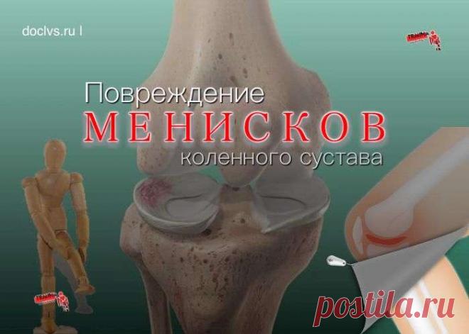 Травма мениска может произойти от неудачного движения даже при обычной ходьбе, если человек споткнулся, оступился, слегка подвернул ногу или ударился коленом.