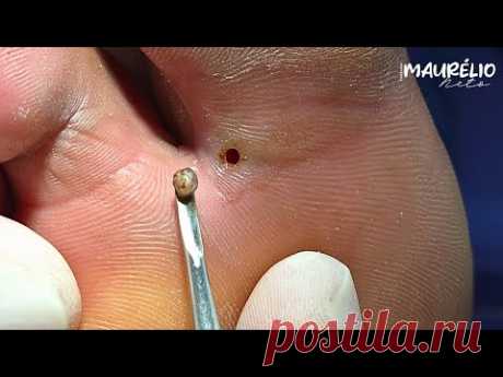 UN PUNTITO CONM PICAZÓN EN EL PIE