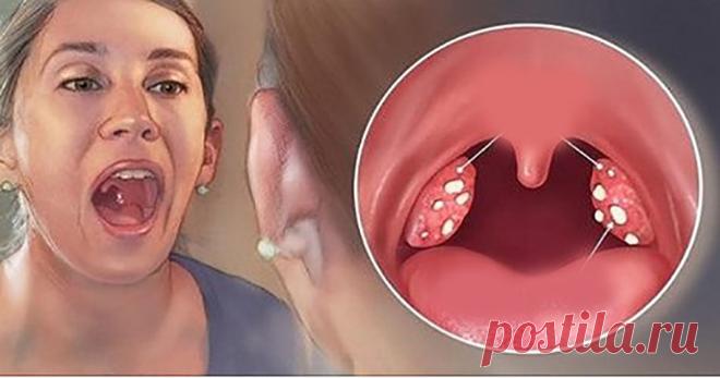 4 эффективных способа удаления камней на миндалинах без хирургии! - Журнал для женщин С этим легко бороться! Миндалины — это лимфоидная ткань в задней части горла. Они имеют мягкую текстуру, и иногда могут воспаляться и заражаться, приводя к раздражению горла, неприятному запаху изо рта, затруднениям глотания и проблемам с дыханием. Хроническое воспаление в миндалинах обычно вызвано большими миндалинами и плохой гигиеной полости рта. Тысячи людей страдают от миндалин, […]