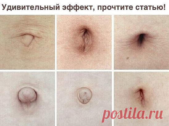 Вы знали, зачем смазывать пупок маслом?

 В моей практике был один запоминающийся случай, после которого, я аспирант тогдашнего Ленинградского мединститута, стал собирать всю информацию и печатную, и устную, от других коллег и своих пациентов, об этом важном отделе нашего тела 