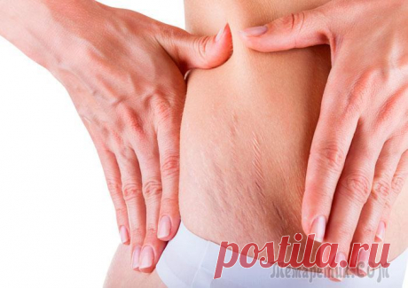 Как избавиться от растяжек натуральными средствами Множество вещей влияют на вашу жизнь после родов. Кроме более напряженного графика вы обнаружите, что ваше тело не такое, каким было до беременности. Например, потеря лишнего веса может занять некотор...