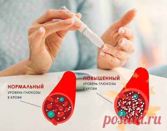 Норма сахара в крови: достоверная таблица по возрастам Таблица с нормой сахара в крови по возрастам, анализы для определения уровня глюкозы, что такое гипогликемия и гипергликемия, профилактика неотложных состояний.