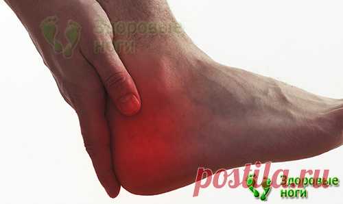 Топ-10 методов лечения пяточной шпоры в домашних условиях. Проверенные рецепты, как вылечить пяточную шпору на дому